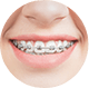 Close up of smile with traditional braces