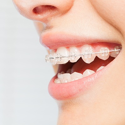 Patient in Enfield smiling with ceramic braces