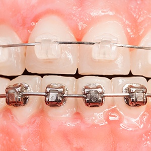 Side-by-side comparison of ceramic brackets and traditional metal braces
