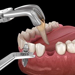 an example of an excessive overjet orthodontic issue