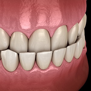 a digital illustration of an underbite