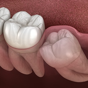 an example of an impacted tooth
