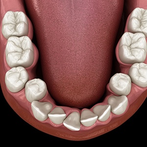 a digital illustration of overcrowded teeth