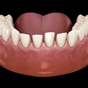 an example of gaps between teeth
