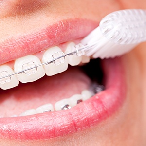 Closeup of person brushing teeth with traditional bracket and wire braces