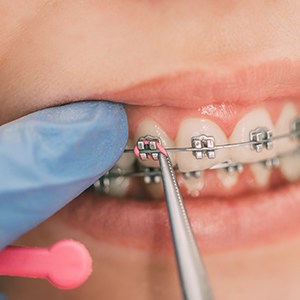 Orthodontist repairing damaged braces