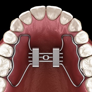 animated rendering of a palatal expander 