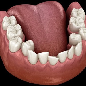 Illustration of crowded teeth