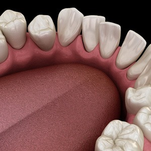 Illustration of gapped teeth