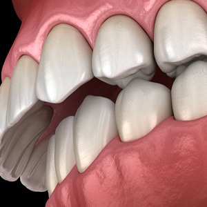 Illustration of overbite