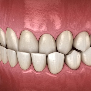 Illustration of underbite