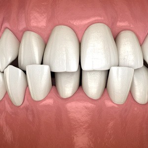 Illustration of crossbite