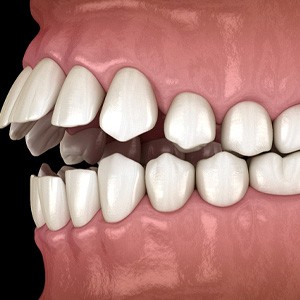 Illustration of openbite