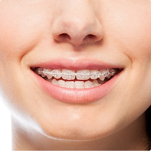 Closeup of smile with clear braces