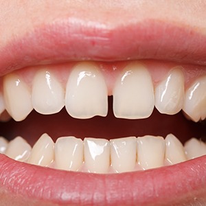 Gapped teeth in Enfield