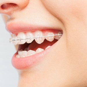 Close-up of person’s smile with clear braces