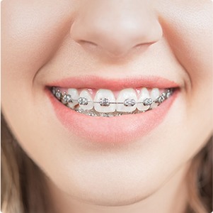 Closeup of smile with traditional brace