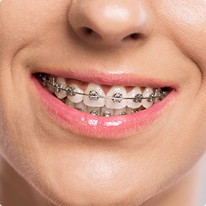 Closeup of patient's smile during orthodontic treatment