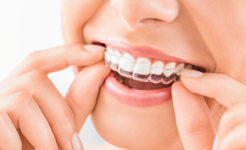 Woman placing clear aligner over her top row of teeth