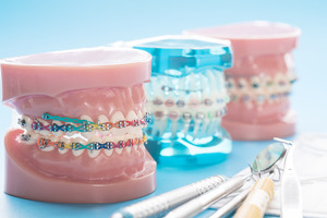 Model teeth with braces of different colors