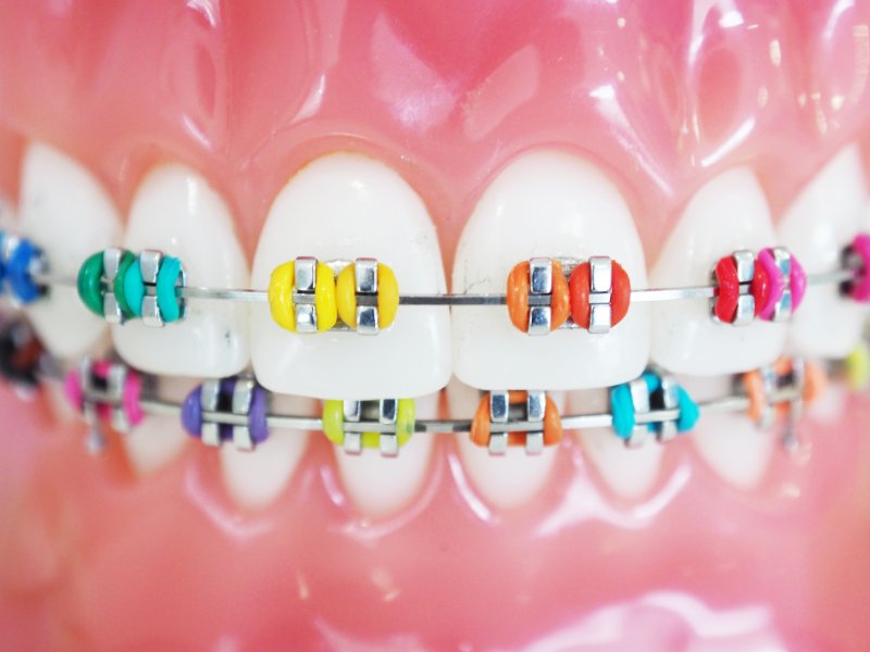Braces with bright rubber band colors