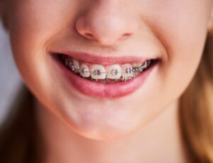 Close-up of child with braces. 